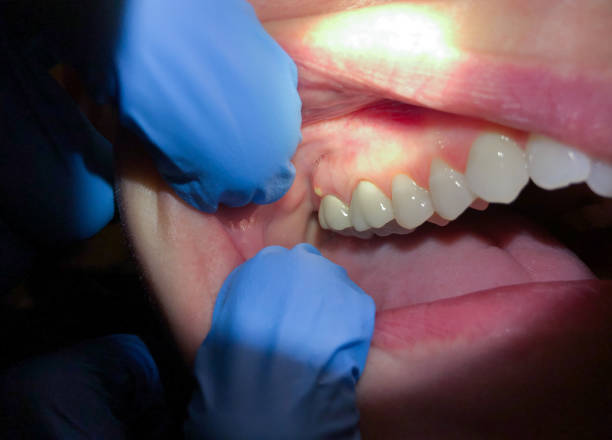 Best Emergency Wisdom Teeth Removal in West Rson, CA